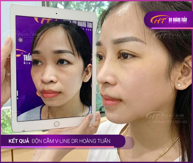 Trước và sau khi độn cằm V Line